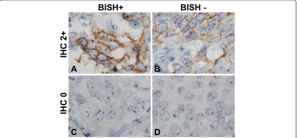 Figure 5 Results of HER2 gene-protein staining of FFPE breast cancer tissues exhibiting heterogeneity of HER2 positive tumor cellpopulations or isolated tumor cell populations