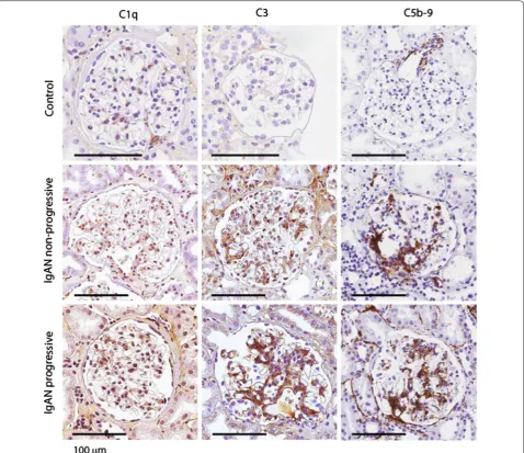 Fig. 2 Representative immunohistochemistry staining images for complement factors C1q, C3 and membrane attack complex (C5b‑9) for a repre‑sentative control, a representative patient with non‑progressive IgAN and a representative patient with progressive IgAN