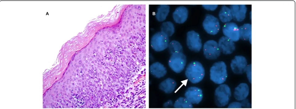 Figure 2 A case of mild dysplasia of the larynx. A. H&E stain. (×200). B. Interphase FISH displaying a CSP3: hTERC signal pattern of 2:2 (green:red)