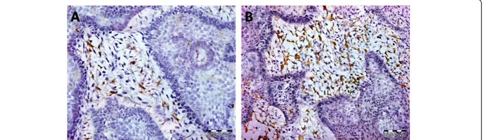 Figure 1 EGFR immunostaining (A) represents membranous and cytoplasmic EGFR expression in basal and stellate reticulum like cells