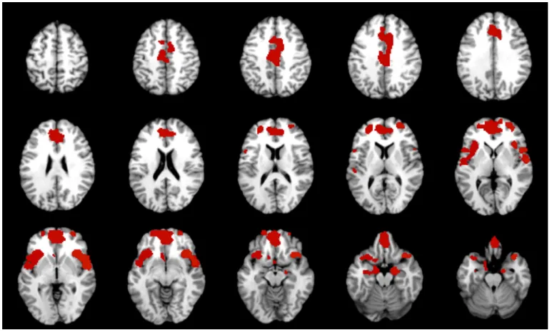 Table 4. Volume reduction in patients with schizophrenia using Dataset A