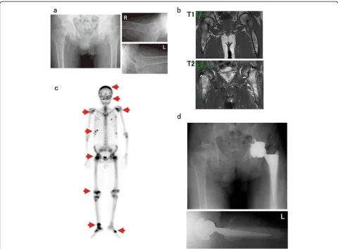 Figure 1 Imaging studies. a: Plain radiographs of both femurs reveal femoral neck fractures