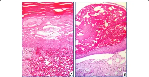Figure 2 Hyperkeratosis (A) and serum exudation within keratin layer in epidermis and enlarged lymphatic vessels (B) in superficialdermis are observed in bullous KS (A-B; H&E, X400).