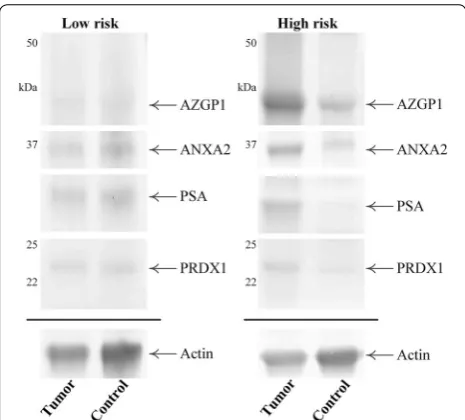Fig. 3 Representative Western blot images of matched tumor and control regions from patients with low or high risk of early bio-chemical failure
