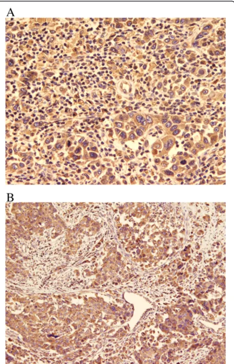 Figure 5 EGFR Immunohistochemical stain. A and B: EGFRpositivity of tumor cells, both the epithelial and the mesenchymalcomponent (DAB, 400 X and 200 X).