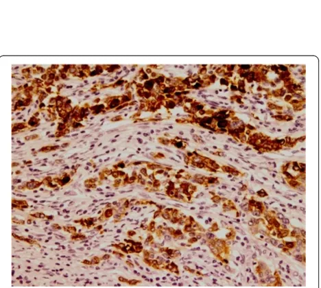 Figure 6 CK19 immunohistochemical stain in MBC. Apositivity in malignant squamous component (DAB, 200X).; CK19 strong B; Strongpositivity of the malignant ductal component for CK19 (DAB, 100X).
