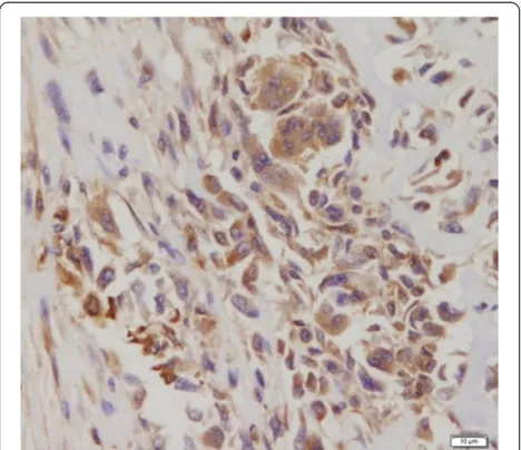 Figure 10 β-HCG immunohistochemical stain. Diffuse positivityfor β-HCG antibodies in giant cells (DAB, 400x).