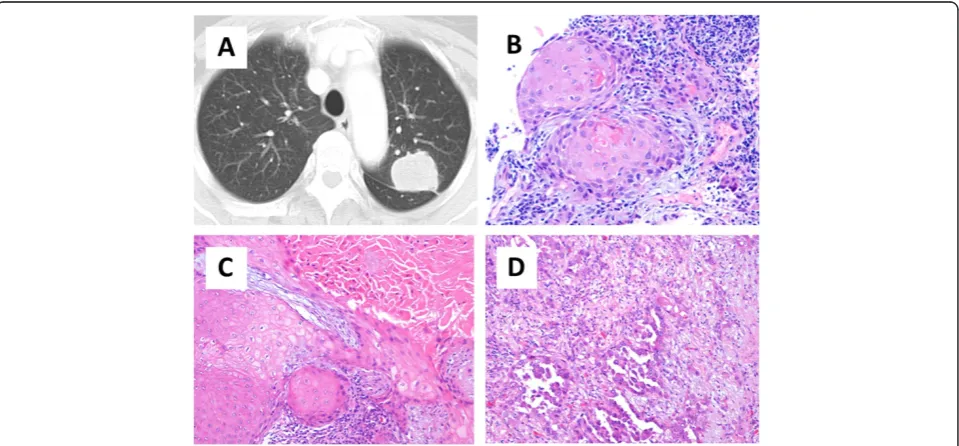 Figure 1 A case with discordant diagnosis of the histological subtype between preoperative and surgical specimens