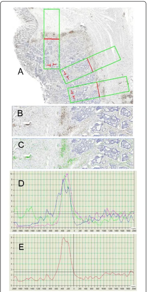 Figure 2 Linear quantification of lymphocytes (LQL) wasperformed on virtual slides (A) on one to eight rectangles of1x4 mm placed across the tumor invasive front