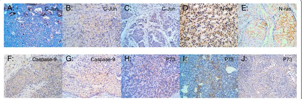 Figure 1 c-Jun, N-ras, Caspase-9 and p73 immunoreactivity in TETs. A-C: c-Jun staining in typeAB, B3 and thymic carcinoma; D,E: N-rasstaining in typeA and B3; F,G: Caspase-9 staining in typeB2 and B3; H-J: p73 staining in typeA, AB and B2