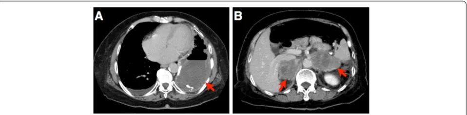 Figure 1 Enhanced computed tomography scan of the chest and abdomen.the left pleural cavity (indicated by a red arrow)