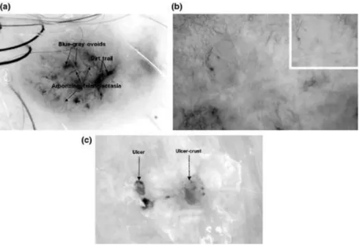 Figure 1. Examples of BCC BASAL structures visible using dermoscopy. All images are contact  dermoscopy images except b