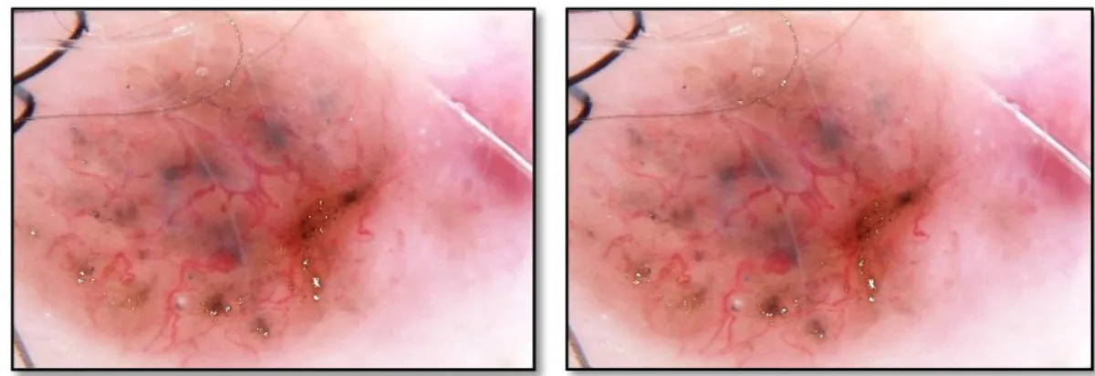 Figure 9. Image overlay.  (a) Image overlay R, after hair and bubble removal. (b) Dirt trail  image overlay K after isolated object removal