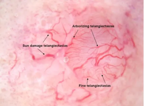 Figure  1.  Telangiectasia  example.  Arborizing  telangiectasia  (trunk  and  branches)  are  the  classical  telangiectasia  seen  in  a  contact,  non-polarized  dermsocopy  image  of  basal  cell  carcinoma (BCC)