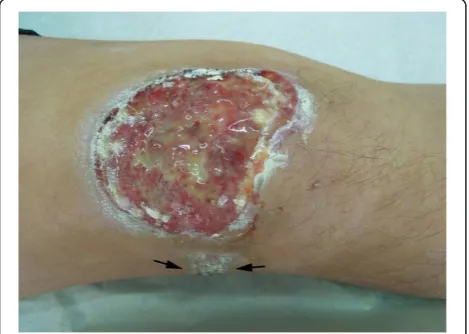 Figure 1 Physical examination showed a 8.0 cm×6.0 cm well-defined ulcerated lesion in the skin of the extensor side of hisright knee