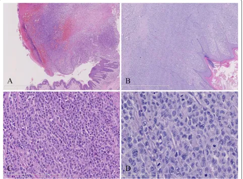 Figure 2A and B, HE staining with original magnification ×40;×200;B) The nodular cutaneous lesion was characterized by DCoval to convoluted nuclei and nuclear groves