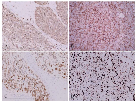 Figure 3 Immunohistochemical analysis of the cutaneous lesions showed tumor cells were diffusely positive for largerin (A), CD1a (B)and S-100 protein (C)
