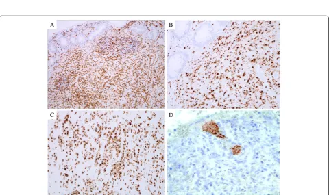 Figure 1 Histological features of the appendix. (A) Atypical lymphoid cells and preserved lymph follicle are in submucosal layer (H&Estain, ×100)
