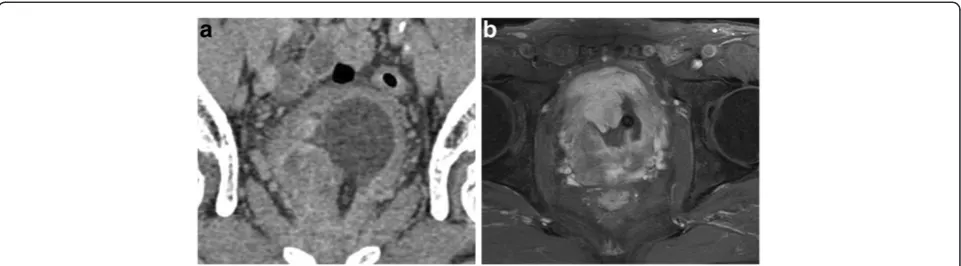 Figure 2 Cut surface of the tumor. The prostate and the bladderspace are widely occupied by the tumor tissue, which exhibited awhitish-yellow multinodular appearance with focal necrosis.