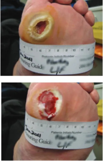 FIGURE 9: Neuropathic ulcer  pre- (top) and post- (bottom)  debridement