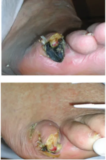 FIGURE 6: Necrotic toe which  has been allowed to  auto-amputate
