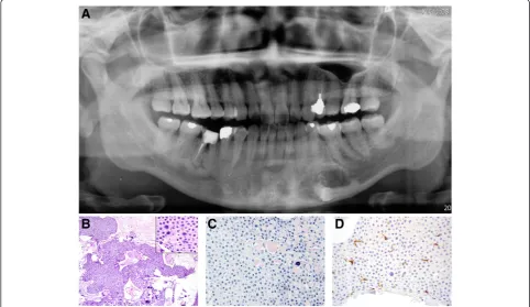Figure 1 Radiographic and histopathologic features of conventional CEOT. Ais seen in the madible between the left canine and the first molar in close association with an unerupted premolar (case 5).composed of masses of polyhedral epithelial cells with som