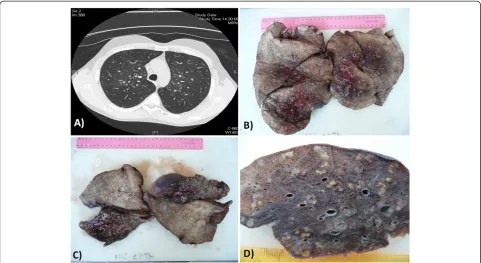 Figure 1 Chest HRCT scan and gross examination of the lungs. (A) HRCT scan: nodular shadows were distributed in a centrilobular fashion,often extending to small branching linear areas of attenuation (“tree-in-bud” pattern); (B-D) gross examination of the lungs showed bilateralmultiple white-yellowish small nodules centred on small airways.