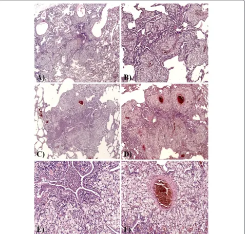 Figure 2 Histological features. (A-D)diffuse involvement of respiratory and terminal bronchioles; most of the histiocytes were foamy macrophages, which formeddistributed especially in the wall of respiratory bronchioles, in the surrounding interalveolar se