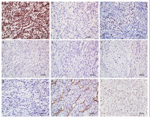 Figure 3 Immunohistochemical studies of the tumor. (a-i) Magnification, ×200. The tumor cells expressed strong immunoreactivity for VIM(a) and negative for CK (b)