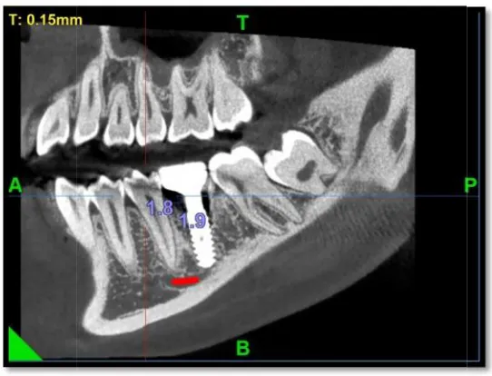 Figure 36: CBCT after 12 months of implant placement.Figure 36: CBCT after 12 months of implant placement.Figure 36: CBCT after 12 months of implant placement.