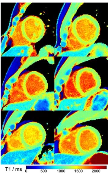 Figure 5. Myocardial T 1 maps of a basal, mid-ventricular and apical section. Single-shot inversion recovery FLASH was performed at 43 ms resolution (19 spokes) for a duration of 3 s.