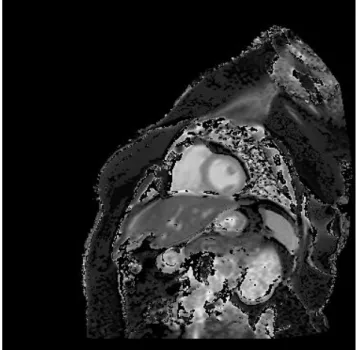 Figure 5: Subject #4 Pre contrast grey scale image from MRMap 