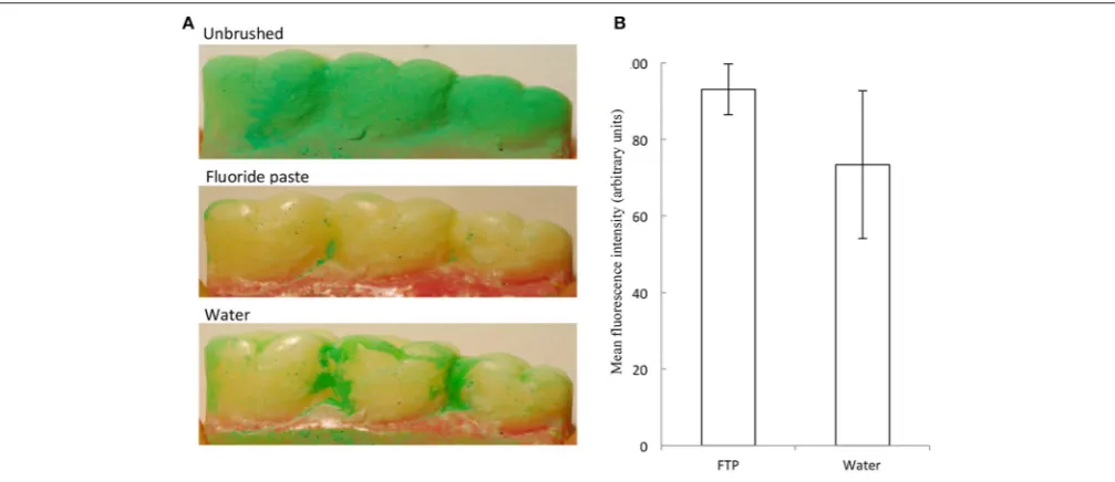 FIGURE 4 | A ﬂuoride toothpaste (FTP) removed more simulated interproximal plaque than water