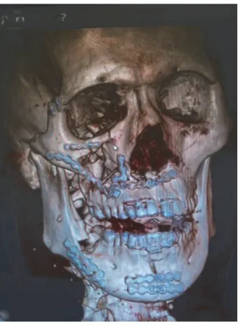 Figure 4: A mixture of 50% of acrylic-glue (Glubran 2) and Lipiodolultrafluid was injected up to the complete occlusion of the lesion.