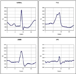 Fig 2 Four common types of heartbeats. [21] 