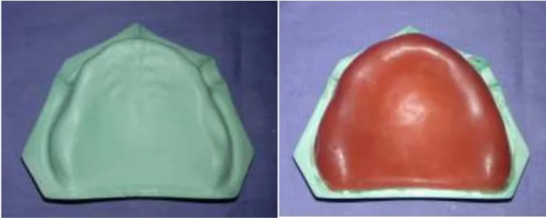 Fig.15: Cast with soft liner 