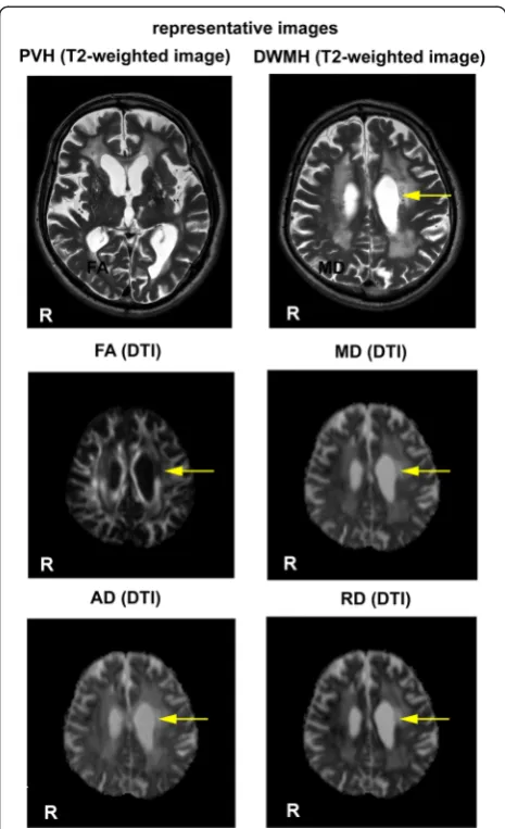 Figure 1 Representative T2-weighted images and maps ofdiffusion measures. Representative T2-weighted images and mapsof diffusion measures of a male subject who is 79 years of ageare shown
