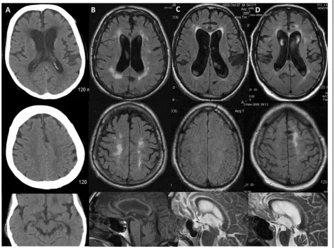 Figure 1 Neuroimaging of the NPH suspected cases. Head CT (A) and FLAIR sequences of brain MRI (B-D) for cases 1–4 (A-D) showed mild tomoderate ventriculomegaly (upper row), with relatively mild or absent (Case 3) associated parenchymal atrophy as judged b
