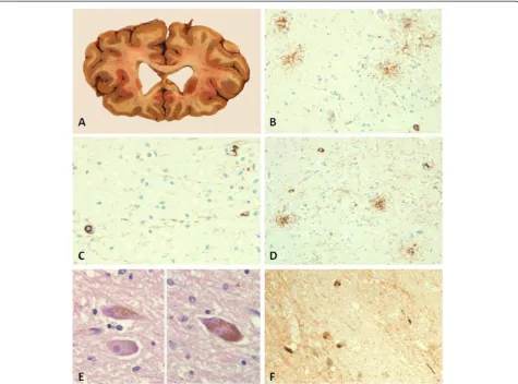 Figure 2 Neuropathology images of selected cases. Aparietal cortex (tau stain (AT8), magnification 200×).
