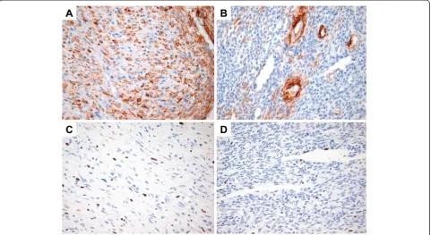 Figure 4 Immunohistochemical findings. A.spindle tumor cells show an increased Ki-67 labeling index (up to 7%) (immunostaining, ×400)