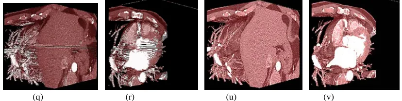 Figure 10.5  (q)3D dilated forms of  toutatix2     (r): Sections from 40th(u) 3D dilated forms of hexagonalized toutatix2  (v): Sections from 40 slice to 100th slice th slice to 100th slice 