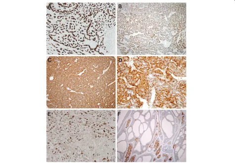 Figure 2 Immunohistochemical findings of basal cell neoplasm and adenoid cystic carcinoma