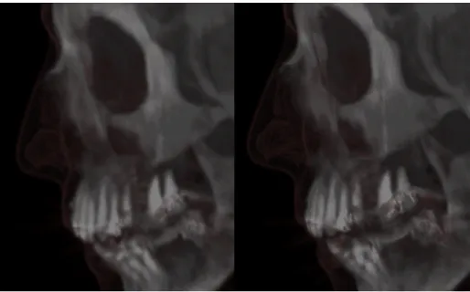 Fig. 1: These images compare a detail in two renditions of the CT head dataset at half viewport resolution (left) and full viewport resolution (right)