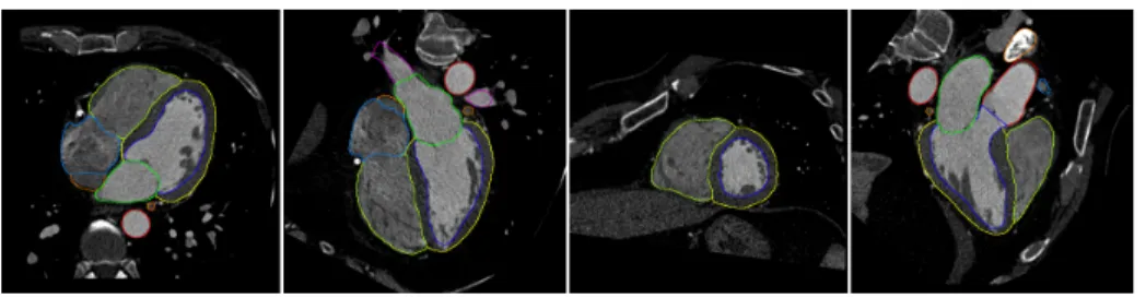 Fig. 2. Four views on one out of the 37 segmented CT data sets.