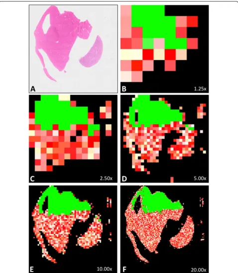 Figure 1 Automatic quality analysis of a virtual slide (parameter used: blur) A represents the thumbnail of a whole slide image (H&Estaining) whose upper third part is in focus and lower two thirds part is totally out of focus