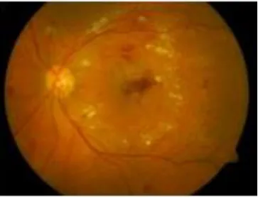 Figure 1.  Fundus image with exudates 