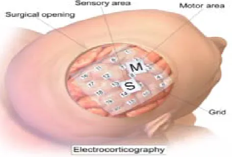 Figure 2.  A Typical EEG based BCI 