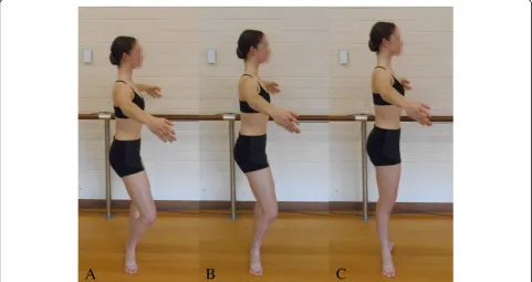 Fig. 2 Hyper-pronation of the foot in forced turnout. Dancerdemonstrating hindfoot eversion, medial bulging of the talar-navicular joint, forefoot abduction, toes gripping the floor and lateraldeviation of the hallux