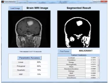 Table II: Parameter Analysis when Benign Tumor and Malignant Tumor Is Detected on Side view of Brain  