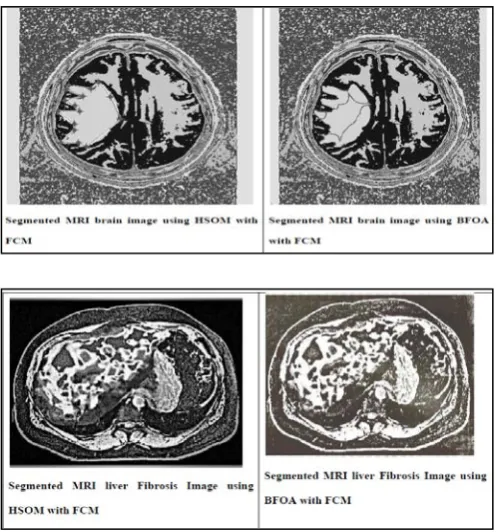 Fig. 2. Segemented MRI Images using FCM  